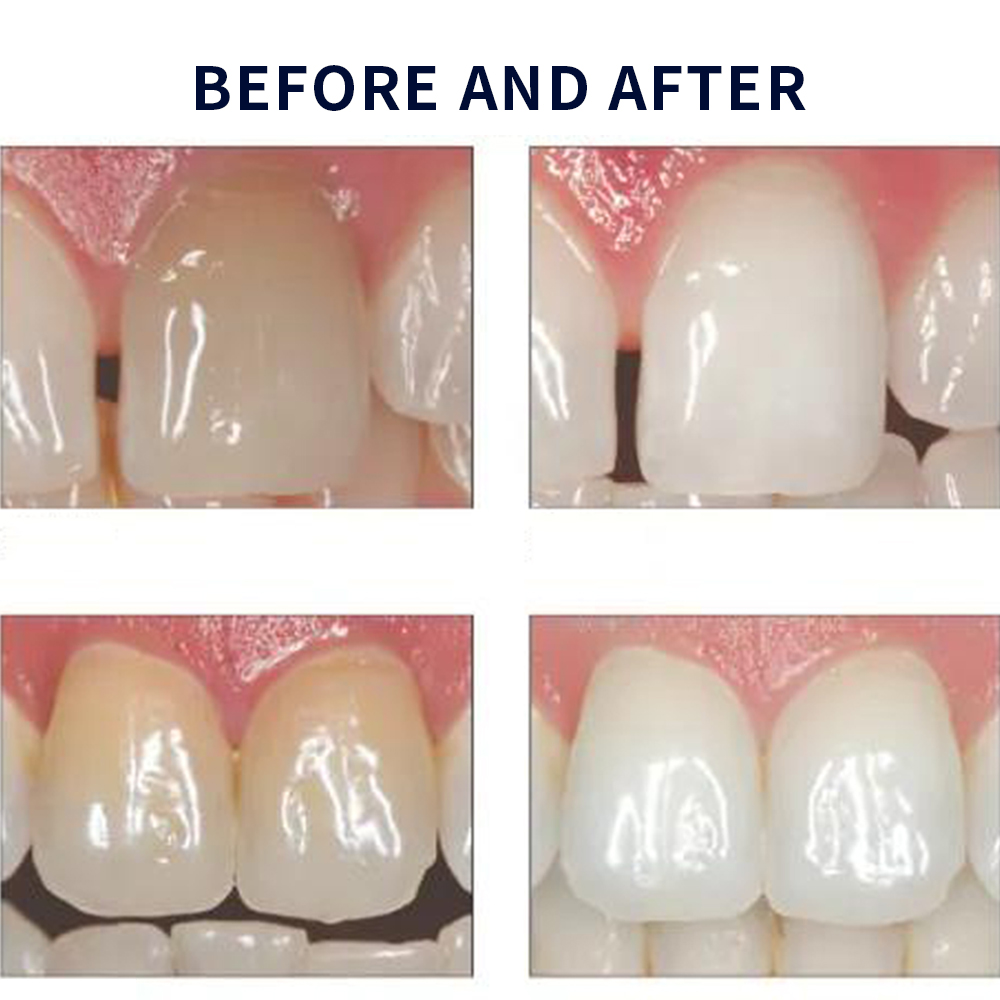 Opalescence Whitening 20% PF 2 - огляд і ціна Teeth Whitening Groupon
