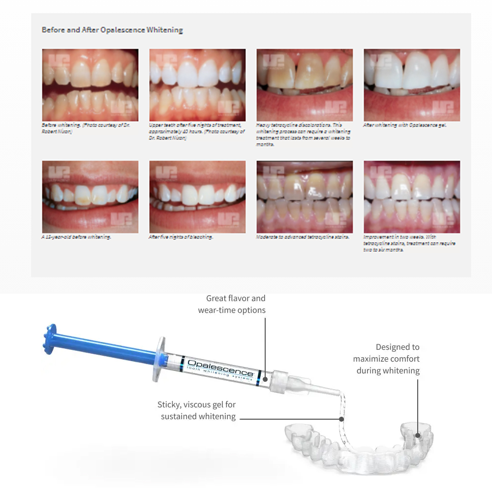 Opalescence Whitening 20% PF 2 - огляд і ціна Teeth Whitening Groupon