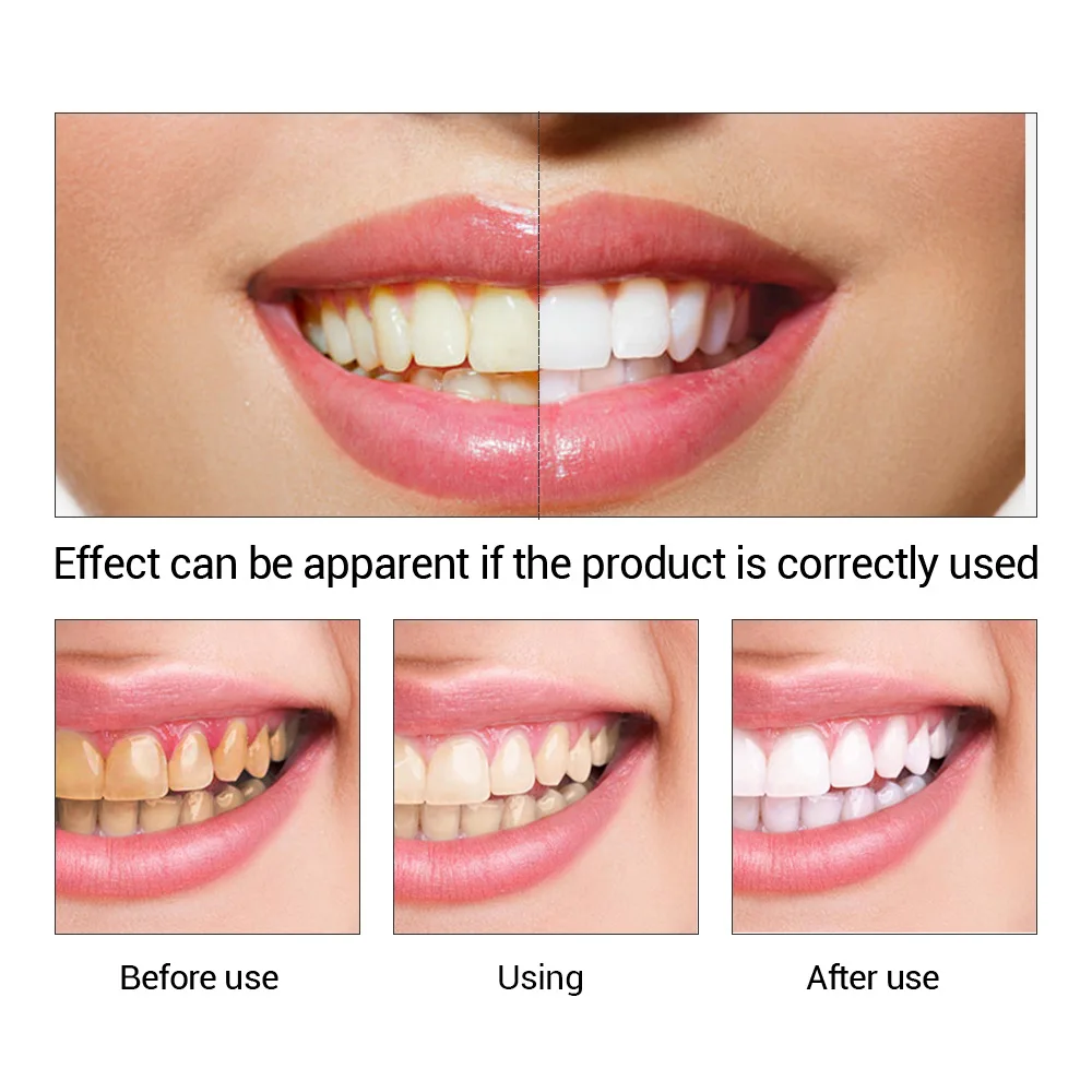 FTEENPLY Teeth Whitening Essen - огляд і ціна Teeth Whitening Groupon
