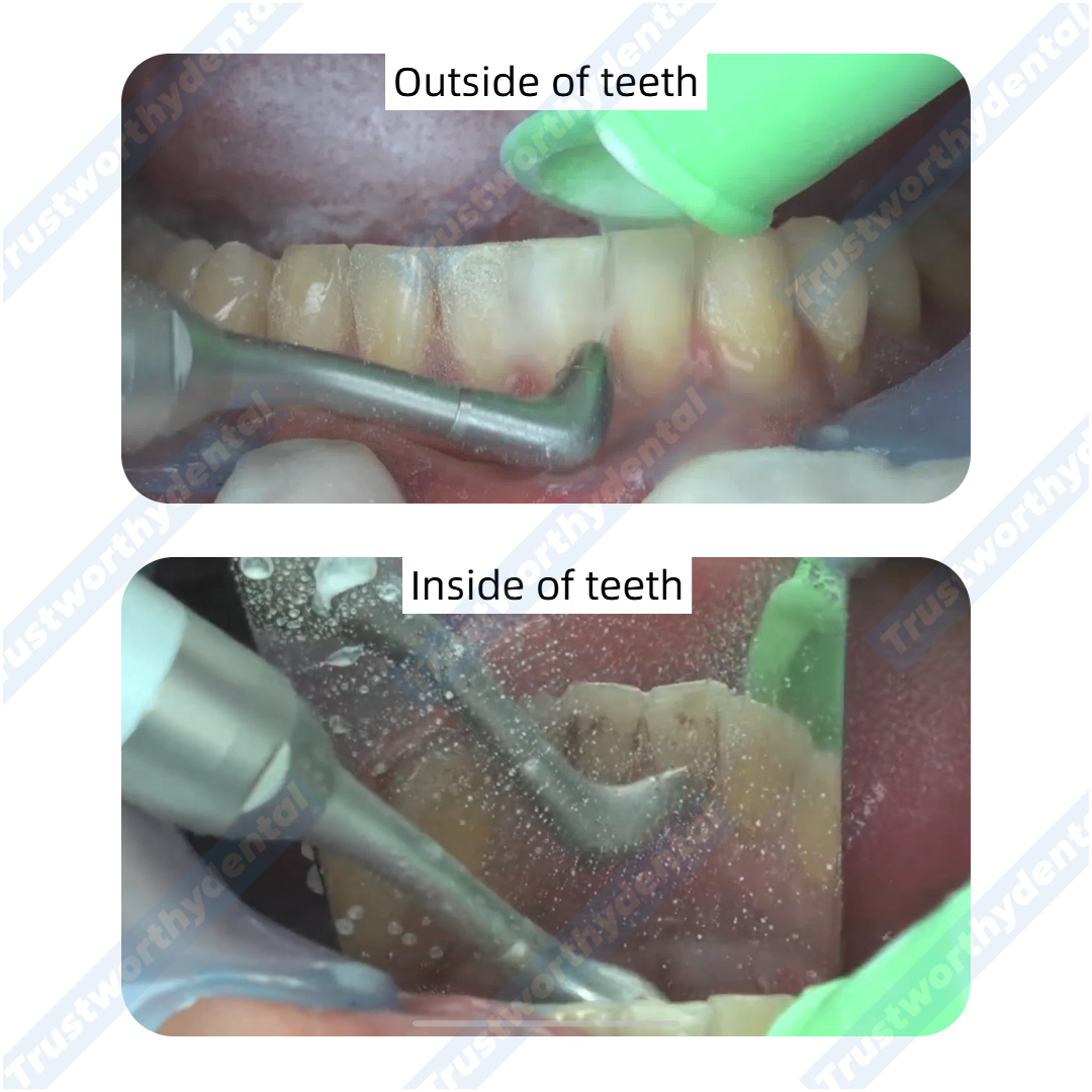 Dental Air Polisher Oral Autoc - огляд і ціна Colgate Whitening Teeth
